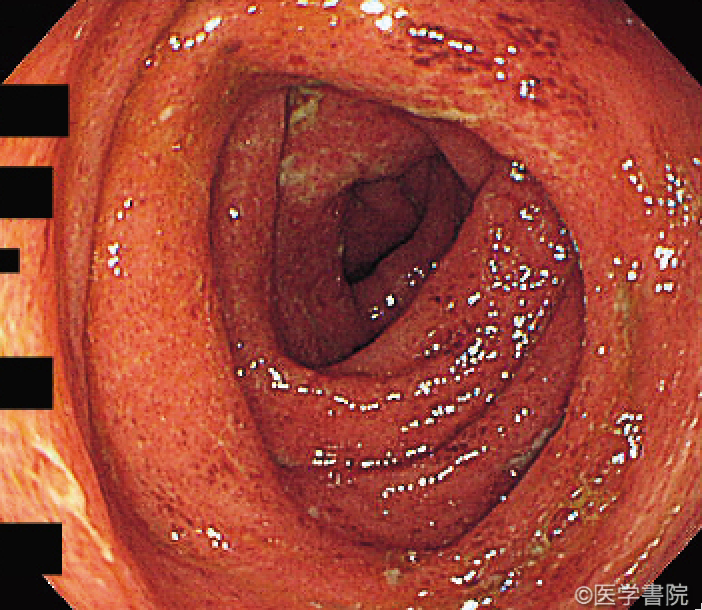 Fig. 1　カンピロバクター腸炎の内視鏡像．全周性，びまん性に浮腫と粘膜内出血がみられる．潰瘍性大腸炎に類似した内視鏡像を示しているが，他部位では非連続性病変がみられ，鑑別が可能である．