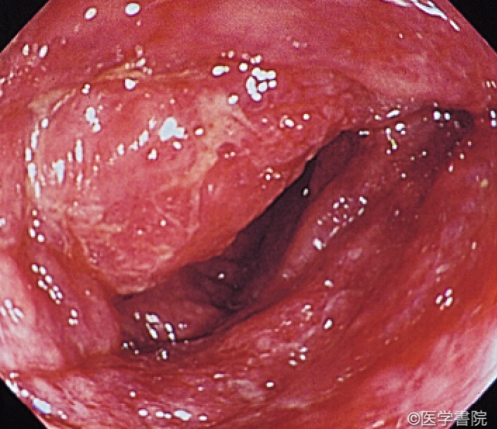 Fig. 1a　O157 出血性大腸炎の内視鏡像． 上行結腸．著しい浮腫による管腔の狭小化，全周性・高度の発赤，びらん，易出血性粘膜がみられる．　〔文献2）より転載〕
〔文献2）より転載〕
