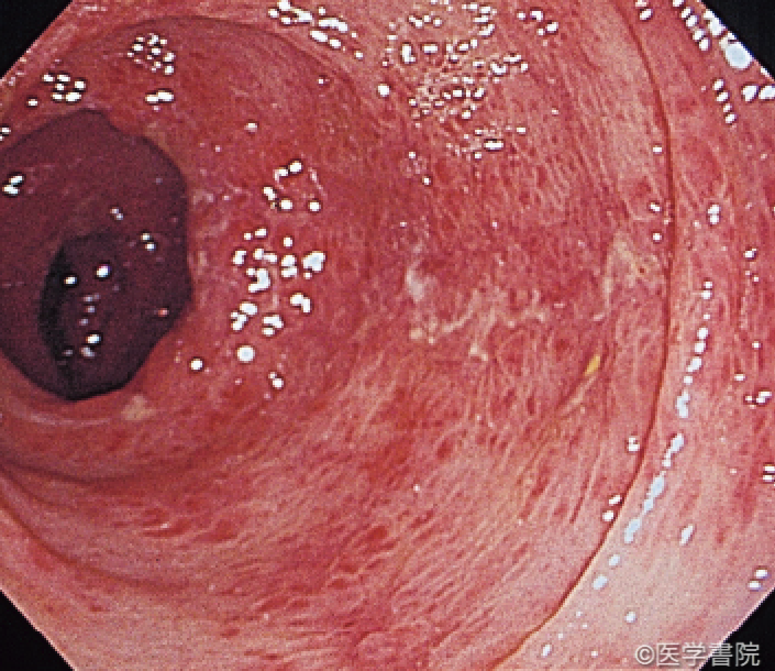 Fig. 1b　O157 出血性大腸炎の内視鏡像． 下行結腸．右側結腸に比し，炎症所見は軽い．
　〔文献2）より転載〕