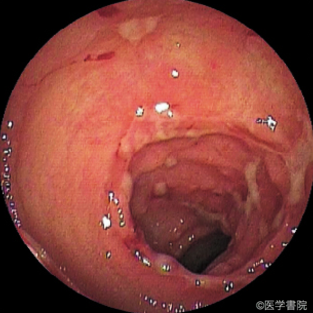 Fig. 1a　CMV 感染性小腸炎． 空腸を中心に不整形地図状潰瘍，類円形潰瘍，びらんが多発している．　　 〔文献1）より転載〕