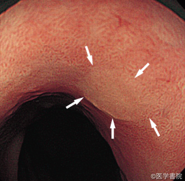 Fig. 1　腺腫（腸型，白矢印で囲まれた部分）の内視鏡像．