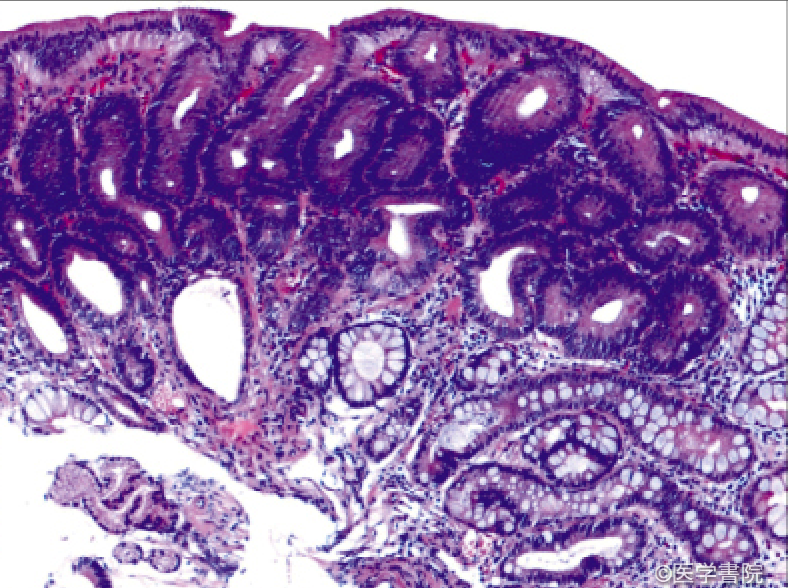 Fig. 2　腺腫（腸型）の生検組織像．