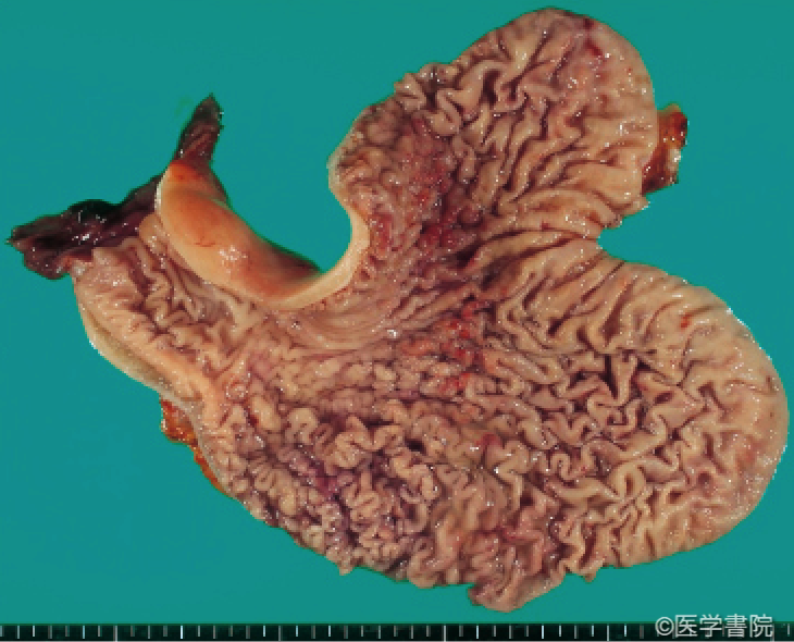 Fig. 1b　スキルス胃癌．　手術標本．