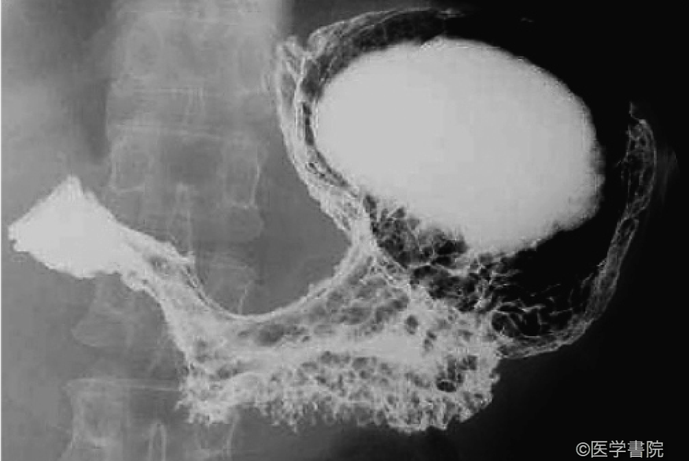 Fig. 1a　スキルス胃癌．　X 線透視．
