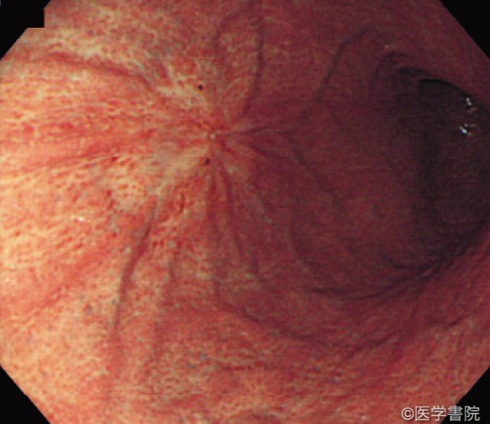 Fig. 1a　早期胃癌（0-IIc 型）類似型胃MALT リンパ腫．体中部前壁にひだ集中を伴う褪色調の陥凹性病変を認める．未分化型早期胃癌との鑑別が必要であるが，境界は不明瞭であり，蚕食像も明らかでないことから鑑別は可能である．胃内には同様の病変が多発していた．