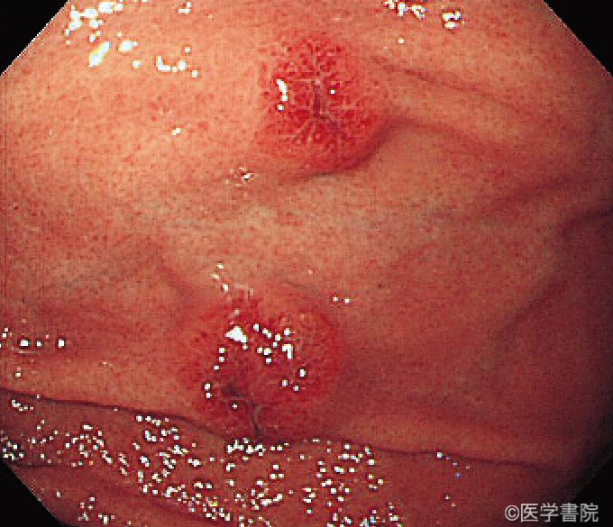 Fig. 1b　Kaposi 肉腫の胃病変．隆起の中央部にdelle様の陥凹を認める．