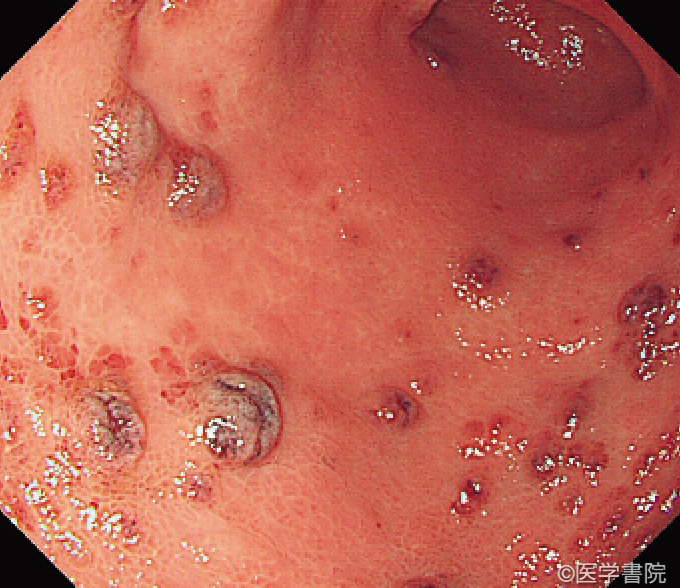 Fig. 1a　Kaposi 肉腫の胃病変．  暗紫色調の粘膜下腫瘍様の隆起性病変が多発している．