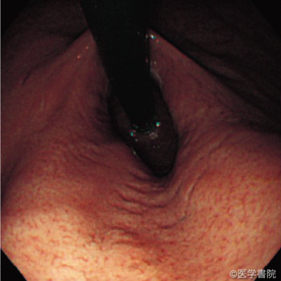 Fig. 1　Crohn 病胃病変の内視鏡像(a)．インジゴカルミン散布によりわずかな竹の節状外観を認識できる(b）．　　　　　　　　　　　　　　　　　　　　　　　　　　a
　　　　　　　　　　　　　　　　　　　