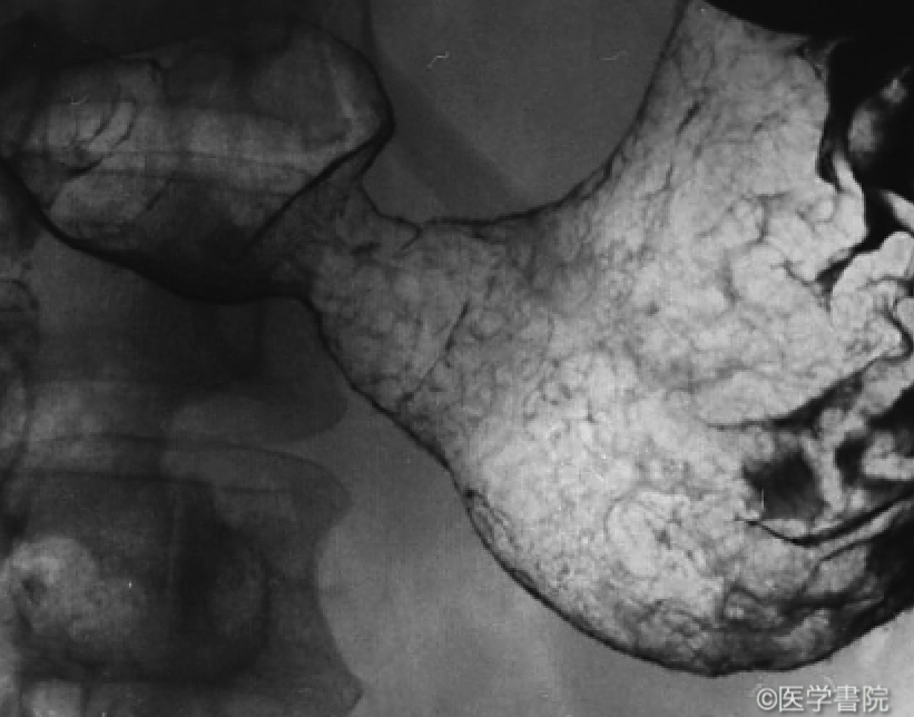 Fig. 1　胃梅毒のX 線像．幽門前庭部に全周性の漏斗状狭窄を呈し，同部の粘膜は凹凸不整を呈している．