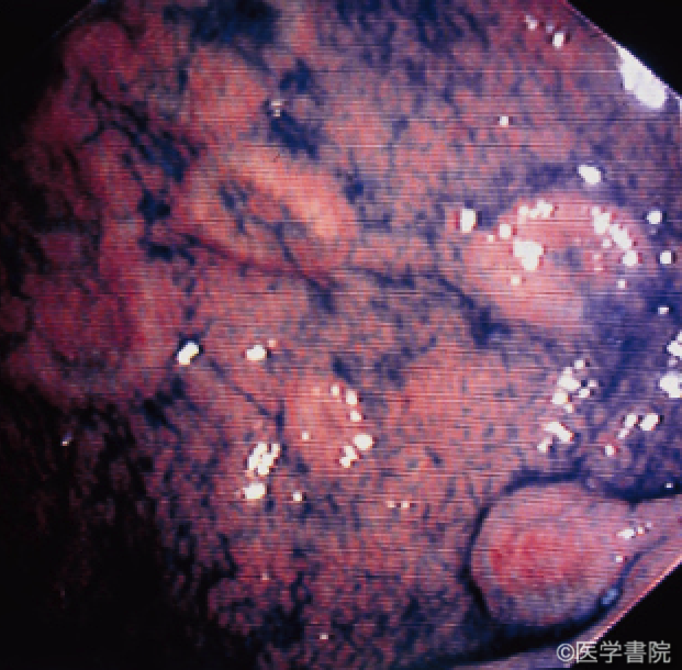 Fig. 2　胃梅毒の内視鏡像．胃体部に梅毒性皮疹（陰部周囲に生じる扁平コンジローマ）類似の粘膜病変が認められる．