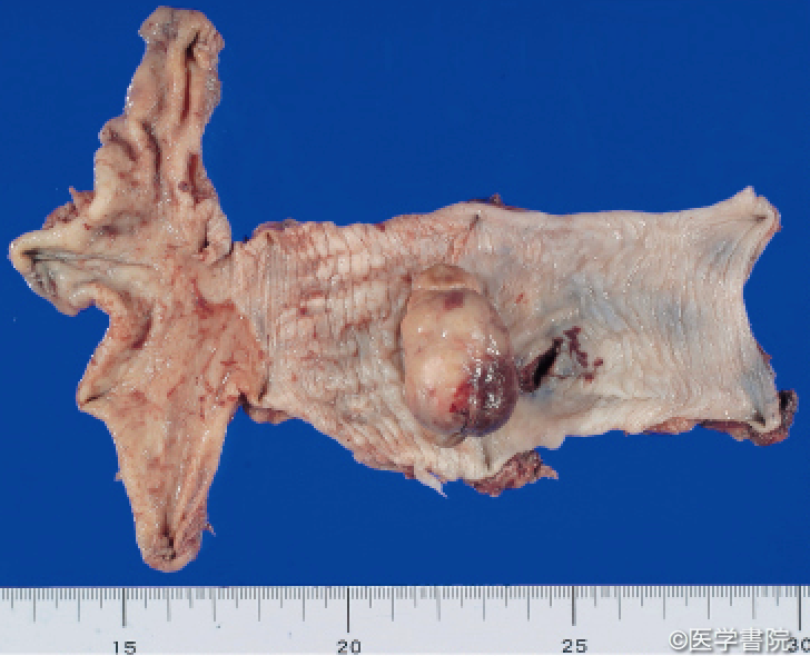 Fig. 1a　食道癌肉腫の肉眼像．