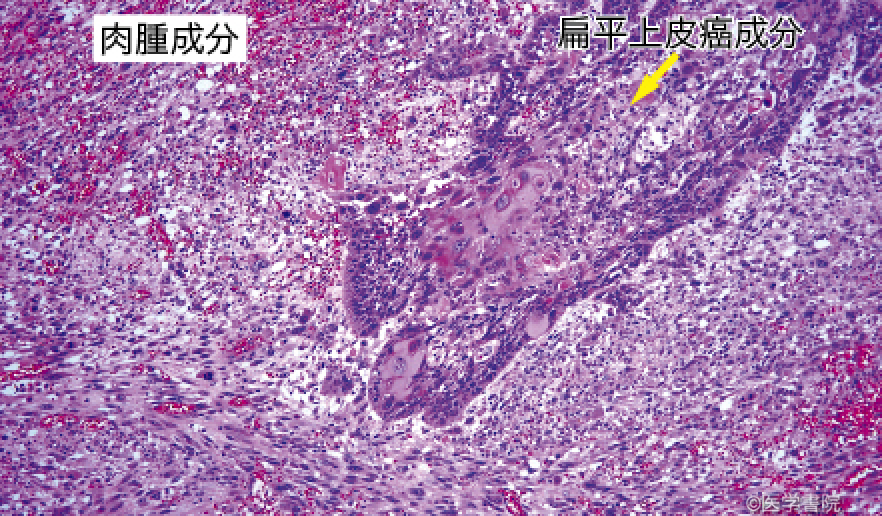 Fig. 1b　食道癌肉腫の病理像．　　　　　　　　　　　　　　　　　　　