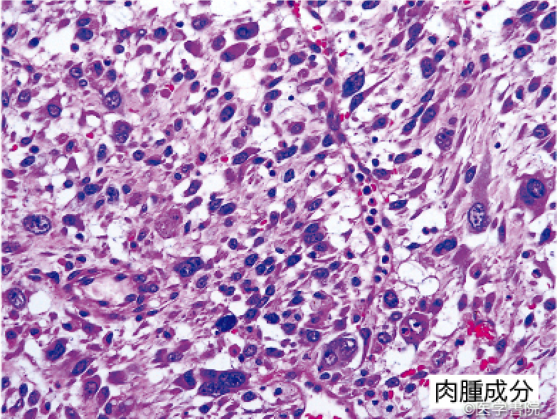 Fig. 1d　食道癌肉腫の病理像．　　　　