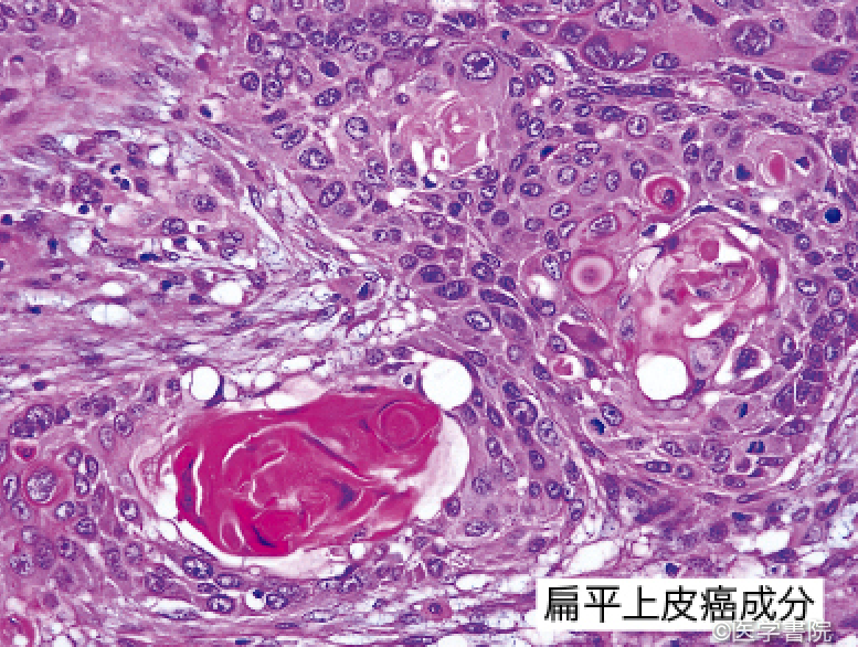 Fig. 1c 食道癌肉腫の病理像．　　　　
