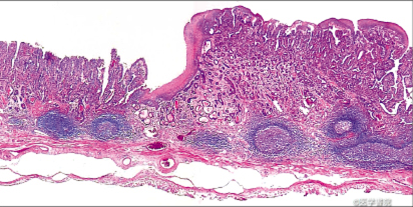 Fig. 2b　食道胃接合部腺癌．高分化型腺癌．
