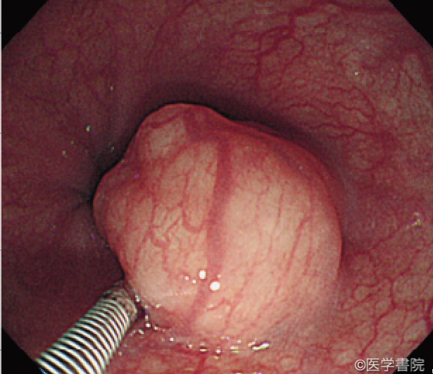 Fig. 1a　平滑筋腫．黄白色調で健常の扁平上皮に被覆された粘膜下腫瘍である．