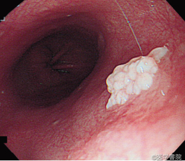 Fig. 1c 　乳頭腫．白色のイソギンチャク状隆起がみられる．