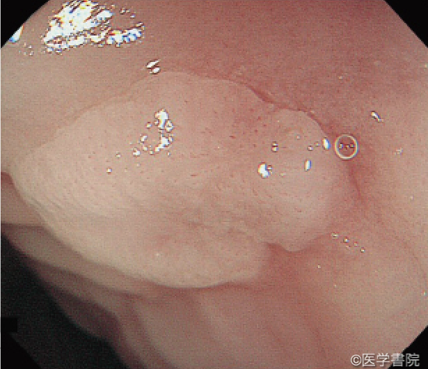 Fig. 1b　乳頭腫． 扁平状で表面には規則正しい乳頭状構造がみられる．