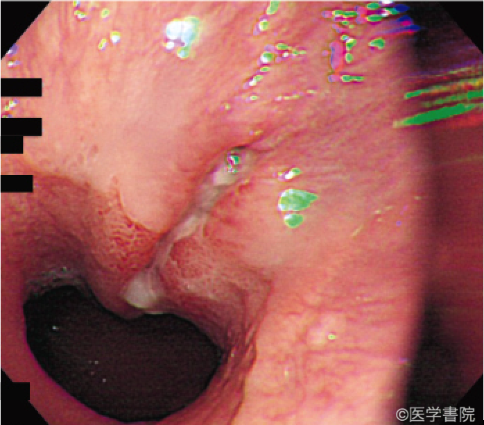 Fig. 1a　Zeifer II 型．裂創は食道と胃の粘膜に及んでいる．