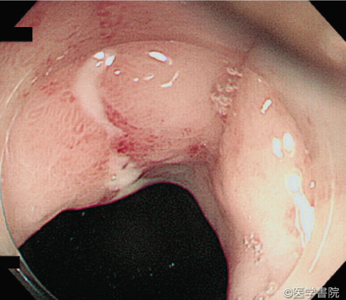 Fig. 1b　Zeifer III 型．裂創は胃側の粘膜にのみ観察される．
