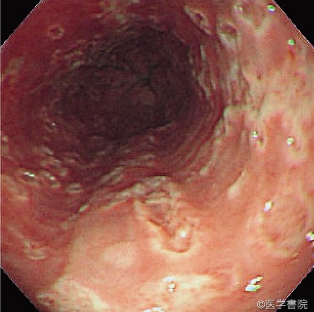 Fig. 1a 　ヘルペス食道炎の内視鏡像． 辺縁がやや隆起した浅い潰瘍性病変が多発している．