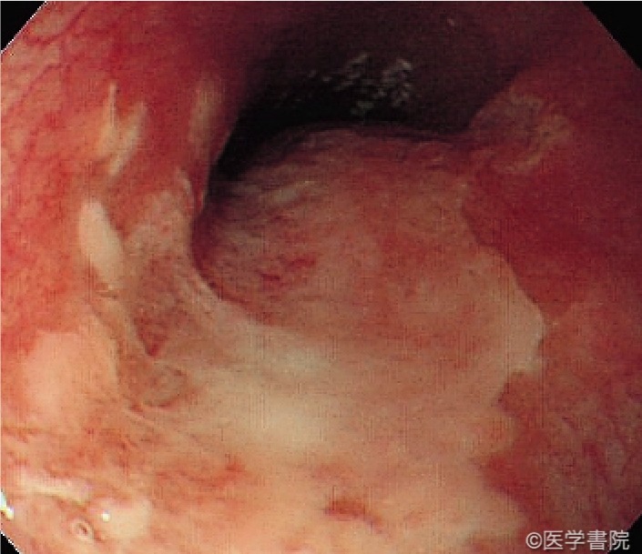 Fig. 1b　ヘルペス食道炎の内視鏡像．口側には癒合した潰瘍，肛門側後壁側には辺縁隆起を伴う浅い小潰瘍を認める．