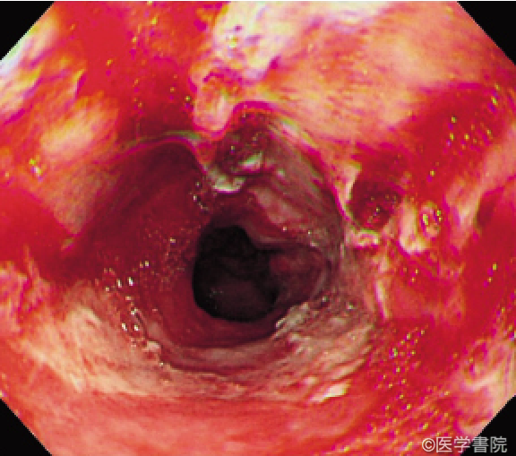 Fig. 1b　腐食性食道炎の内視鏡所見（自損目的での酸性薬剤の飲用症例）． 1 週間後の内視鏡所見．食道粘膜は脱落し潰瘍と出血が目立つ．