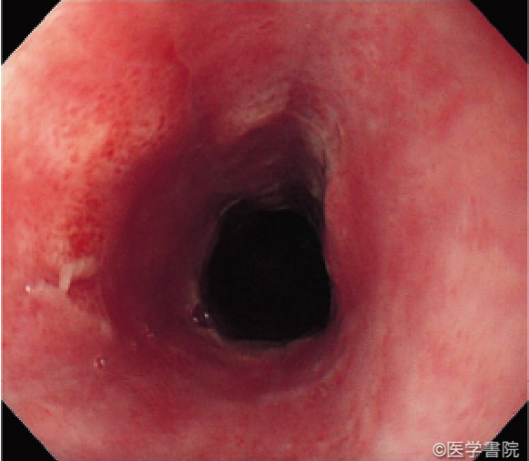 Fig. 1c　腐食性食道炎の内視鏡所見（自損目的での酸性薬剤の飲用症例）．2 週間後の内視鏡所見．目立つ潰瘍は消失し再生上皮化を認める．