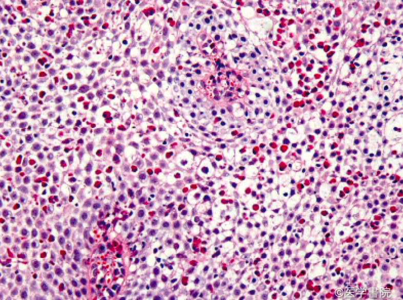 好酸球性食道炎の原因