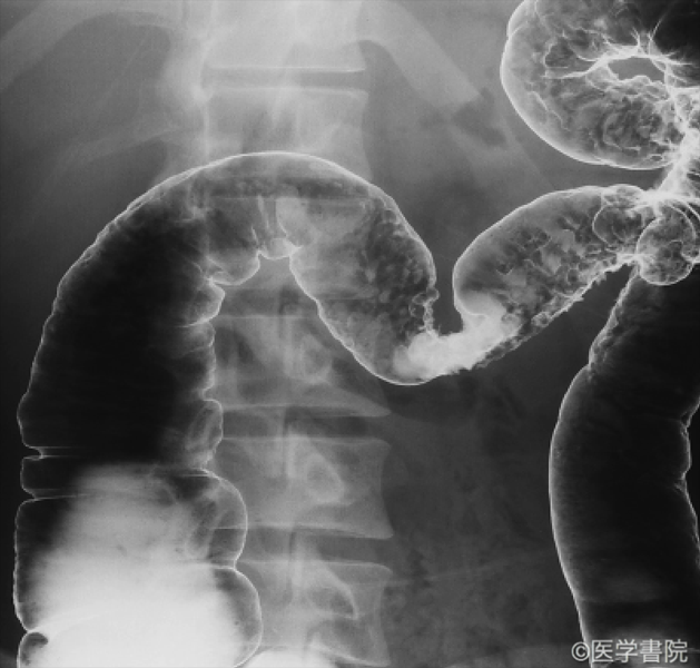 Fig. 1c 2006 年の横行結腸から上行結腸，びまん性炎症に加え敷石像あり．