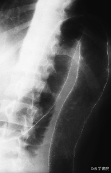 Fig. 1b  2000 年の発症初期の注腸X 線検査 ; 脾彎曲部のびまん性炎症．
