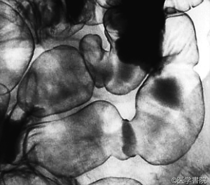 Fig. 1　非特異性多発性小腸潰瘍症のX 線二重造影像．