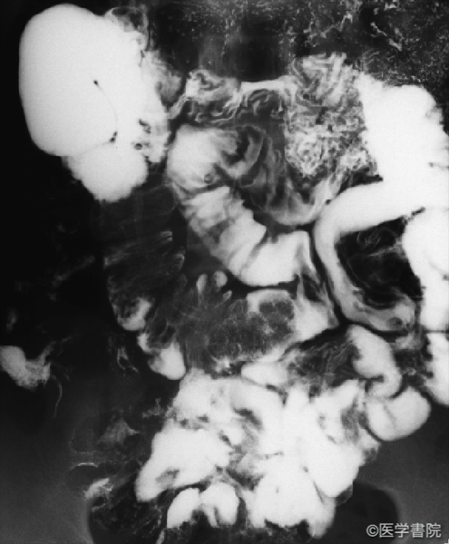 Fig. 1　Peutz-Jeghers 症候群における小腸多発ポリープのX 線像．