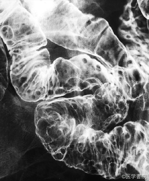Fig. 2　MCL の小腸X 線像．中部小腸に表面平滑な類円形の多発隆起（MLP）を認める．