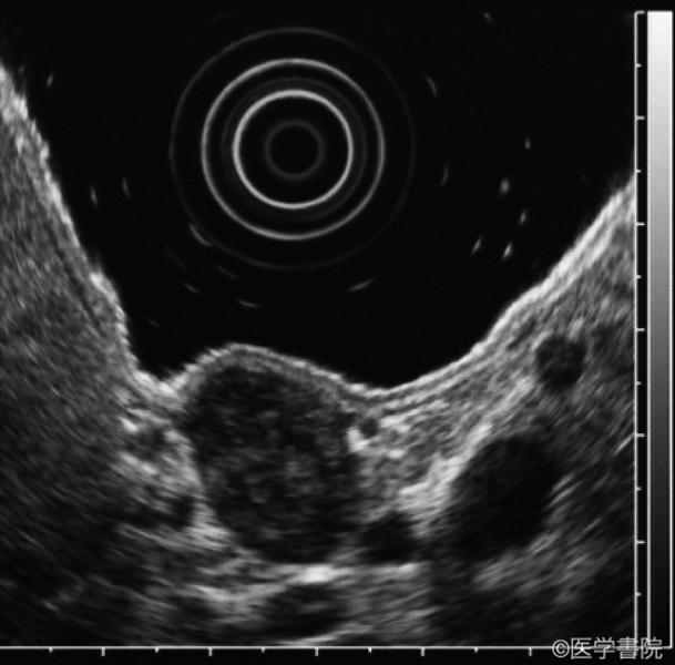 b　 EUS（endoscopic ultrasonography）では，第4 層由来の腫瘍として描出される．