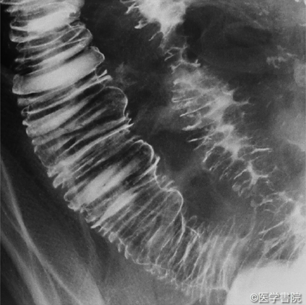 Fig. 1　好酸球性胃腸炎の小腸病変．　　　　　　　　　　　　　　　　　　　　　a　 小腸X 線ではKerckring 皺襞の肥厚，腸管の伸展不良，類円形の透亮像がみられる．
