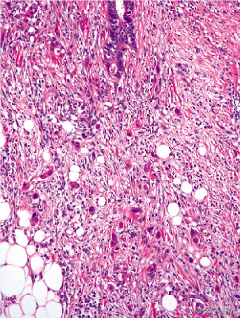 Fig. 1　大腸癌の腫瘍先進部に観察される簇出（HE 染色，対物20 倍）．