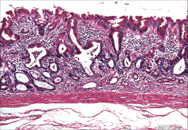 Fig. 1 a　“手つなぎ型腺管癌”のHE 染色像．粘膜中層を中心に細胞異型の弱い細胞より成る腺管が不規則分岐・融合腺管を形成している．