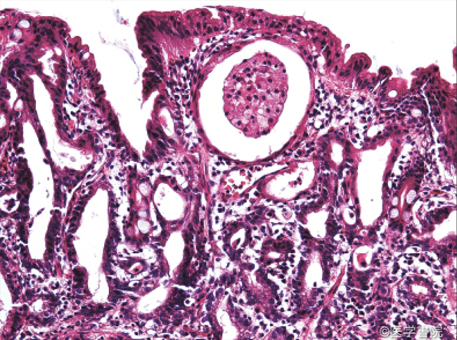 Fig. 1 b　 粘膜表層付近に萎縮した囊胞状腺管を認めるのも“手つなぎ型腺管癌”の組織学的特徴である．