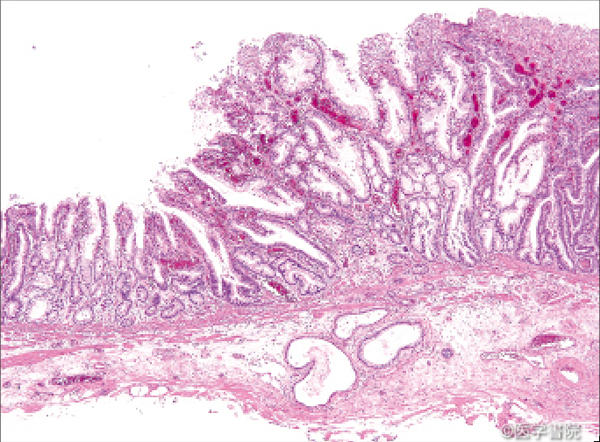 Fig. 1 a　低異型度分化型胃癌．胃型（腺窩上皮型）腺癌で，粘膜下層浸潤を示す．
