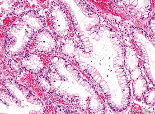 Fig. 1  b　 a の粘膜内病変．細胞異型に乏しく，生検診断は難しいと予想される．