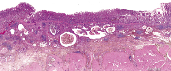 Fig. 2 a　低異型度分化型胃癌（小腸型低異型度癌）．台形～カルデラ状の外観を示す進行癌である．