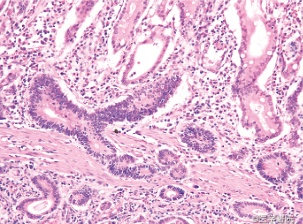 胃の低異型度癌と超高分化腺癌 (ガストロ用語集 2023 「胃と腸」47巻5 