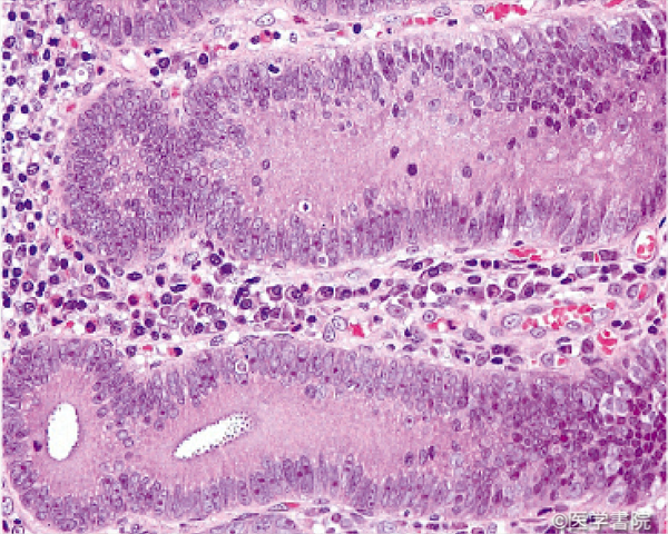 Fig. 1 ｂ　大腸の低異型度癌．