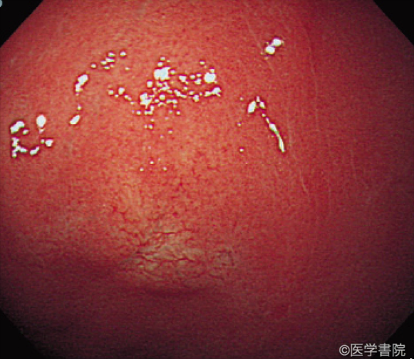 Fig. 1a　胃底腺型腺癌の内視鏡像．
