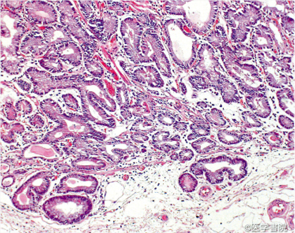 Fig. 1b　胃底腺型腺癌の組織像．