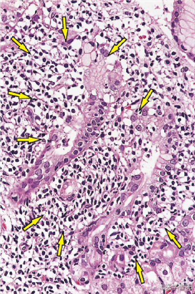 Fig. 1　胃MALT リンパ腫の生検組織（HE 染色，対物レンズ40 倍）．中型異型リンパ球が上皮組織内に浸潤し，リンパ上皮病変（矢印）を形成している．