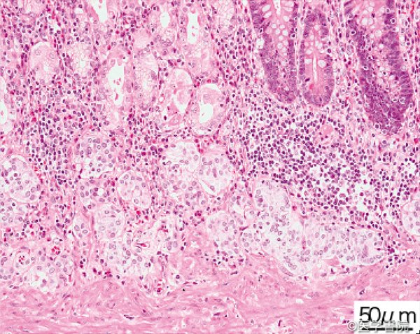 Fig. 1 a　A 型胃炎患者の胃体上部粘膜．種々の形態のECM が粘膜深部に多発している（HE ,20 × 10）．