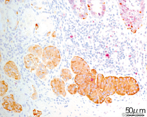 Fig. 1 b　 右下には大型で索状形態を呈しKi-67 陽性細胞を含むECM がみられる〔クロモグラニンA（M0869，mouse monoclonal，1 : 400，DAKO）＋Ki-67（MIB1，mouse monoclonal，1 : 50，DAKO）二重免疫染色，20 × 10〕．