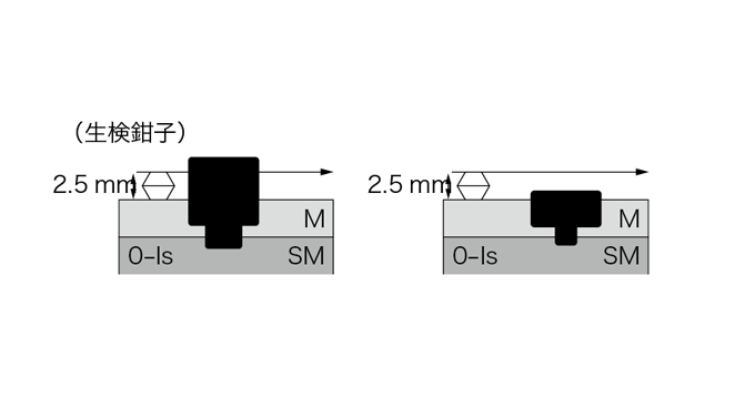 Fig. 3　0-Is と0-IIa の鑑別のシェーマ．閉じた鉗子の高さ2.5 mm を基準とする．
　〔文献1）のDiagram 2，3 より改変して転載〕